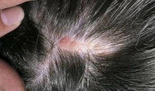 Saçta Yara Belirtileri ve Tedavisi