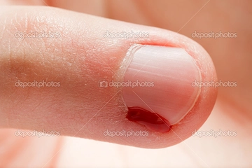 Tırnak Yarası Belirtileri ve Tedavisi