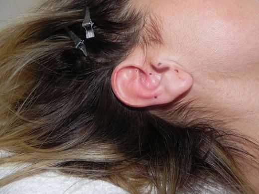 Kulakta Yara Belirtileri ve Tedavisi