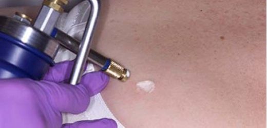 Yara Dondurma Zor Bir Tedavi Midir?