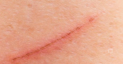 Yara İzi Nasıl Tedavi Edilebilir?