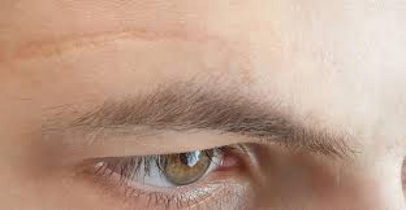 Ameliyat Yaraları Tedavisi