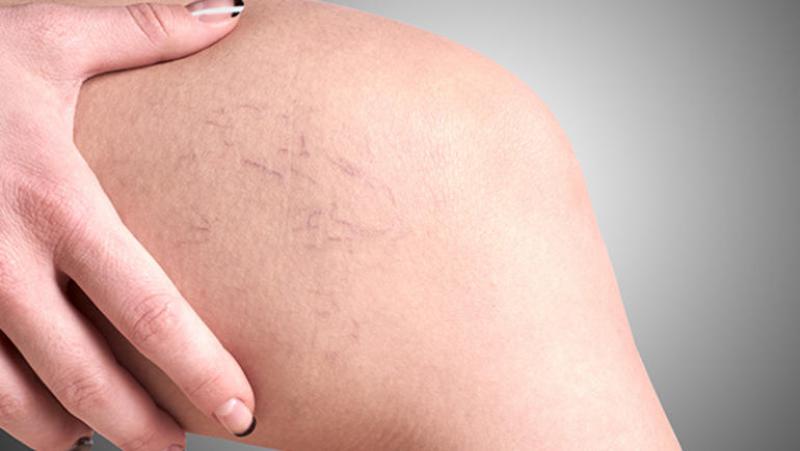 Bacakta Çıkan Yaralar Belirtileri ve Tedavisi