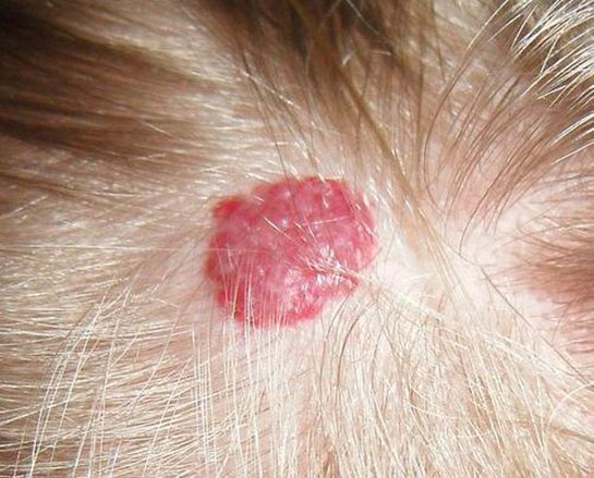 Başta Çıkan Yaralar Belirtileri ve Tedavisi