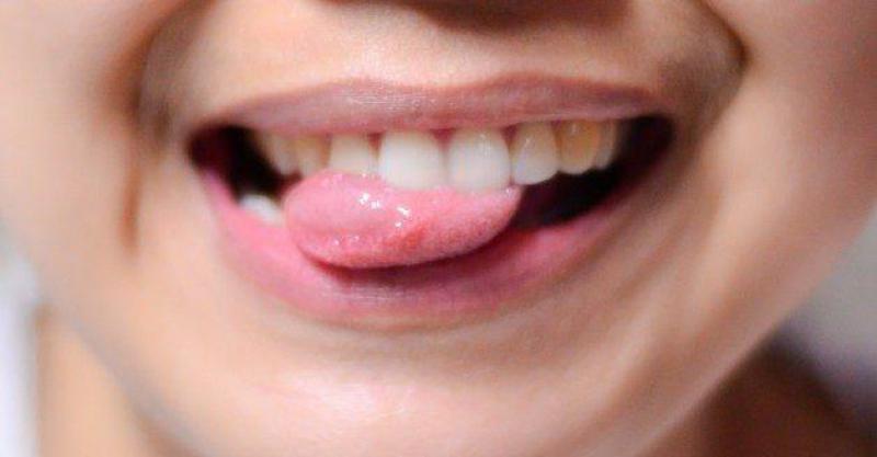 Bebeklerde Damak Yarası Belirtileri ve Tedavisi