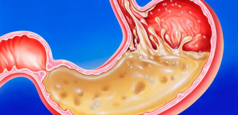 Mide Yarası Belirtileri ve Tedavisi