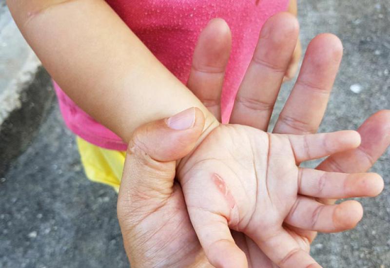 Parmaktaki Yaralar Belirtileri ve Tedavisi