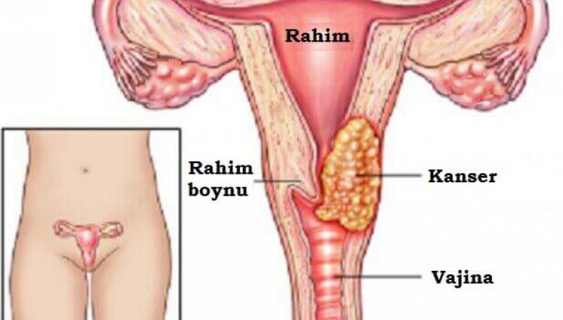 Rahim Yarası Dondurma Sonrası