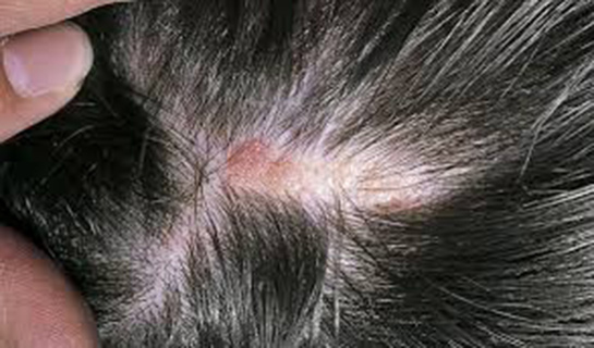 Saç Derisinde Yara Belirtileri ve Tedavisi