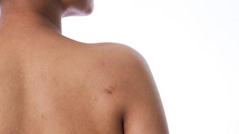 Sırt Yaraları Tedavisi