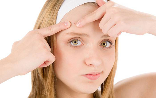 Sivilce Yaraları Nasıl Geçer?