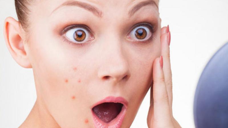 Sivilce Yarası Belirtileri ve Tedavisi