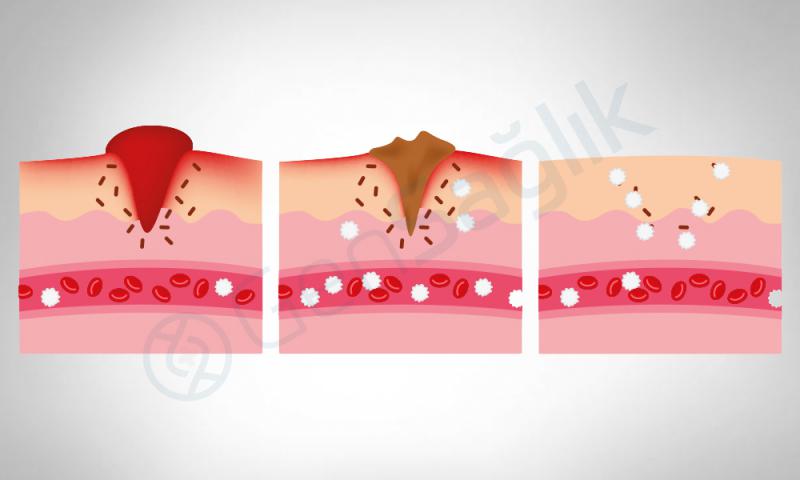 Yara Çeşitleri Nelerdir?