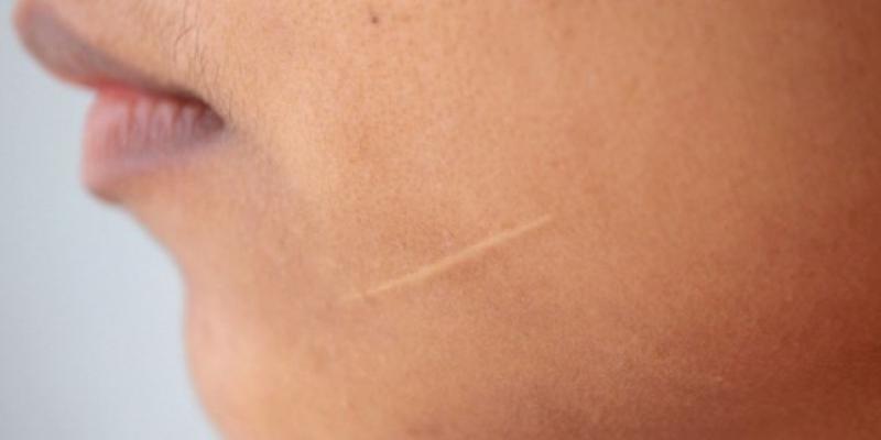 Yara İzi Nasıl Geçer?