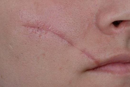 Yara Lekeleri Nasıl Geçer?